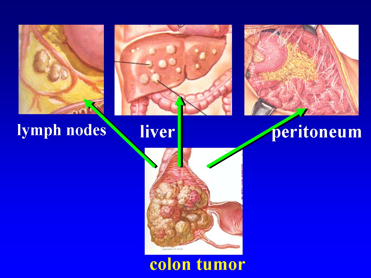Cancer the abdominal wall