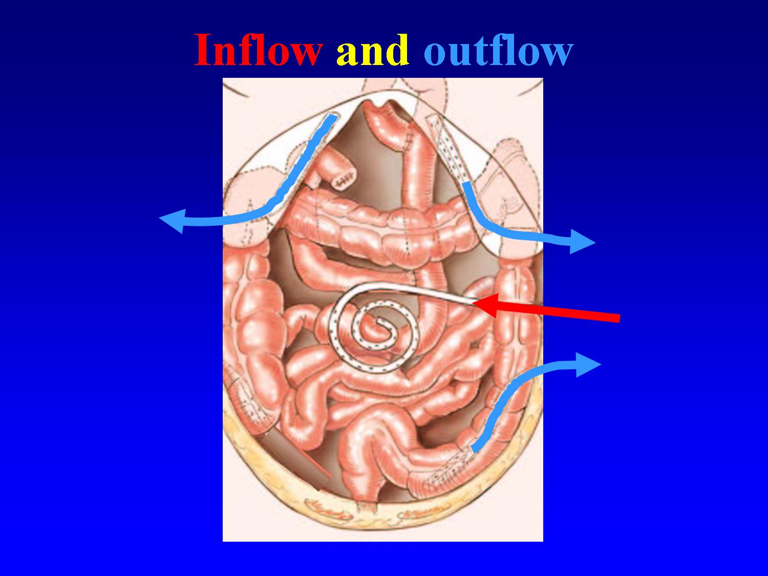 Peritoneal cancer bowel