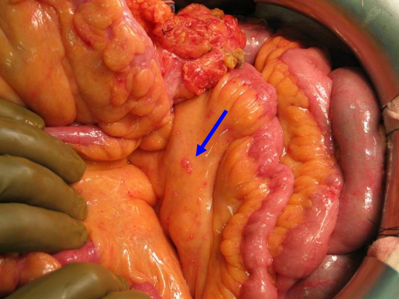 cancer in peritoneal wall)