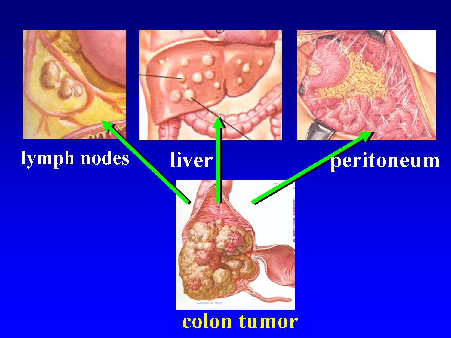 Peritoneal cancer cure. Peritoneal cancer cure rate