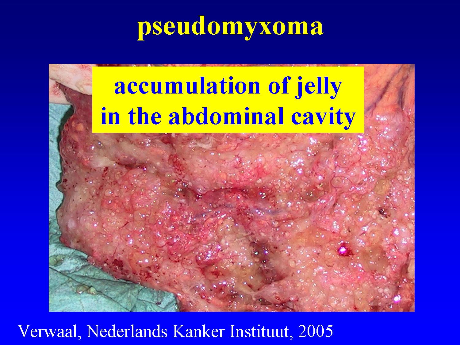 cancer of peritoneal cavity)