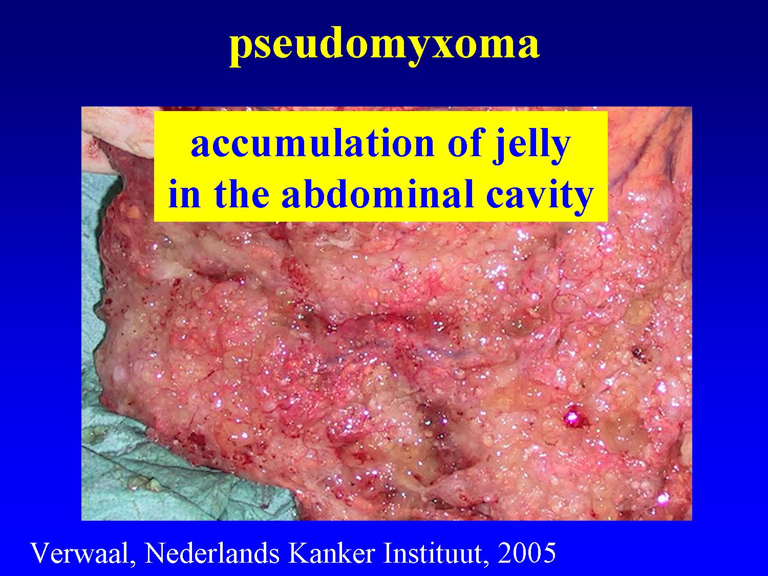 Peritoneal cancer types, Peritoneal cancer with ascites,